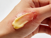 家庭急救：轻微烫伤处理步骤